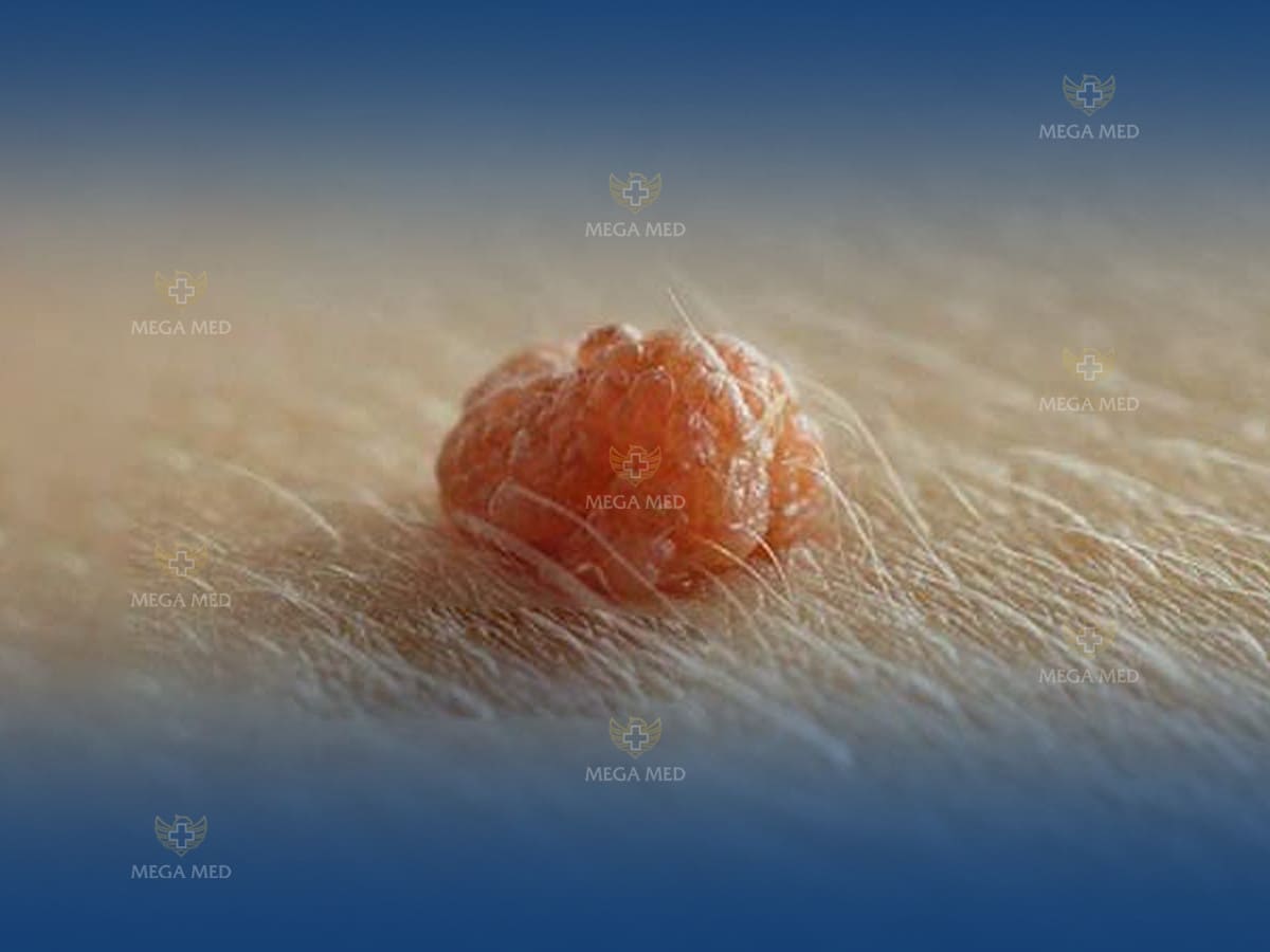 sùi mào gà ở ngực